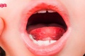 เฮอร์แปงไจนา โรคตุ่มแผลในปากเด็ก