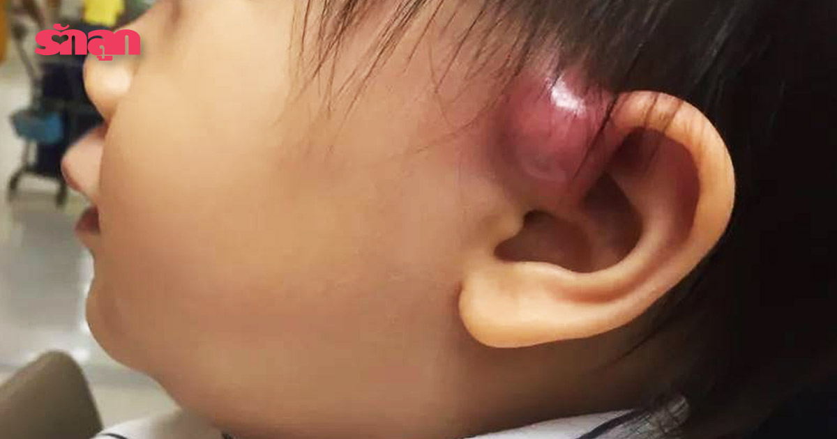 Ear pit- รูหูอักเสบ- มีรูตรงหู- Ear pit อักเสบ- การผ่า Ear pit- โรคภัยในเด็ก- เด็กเรียนว่ายน้ำ- ภัยเงียบ- การเลี้ยงลูกวัย 1-3 ปี