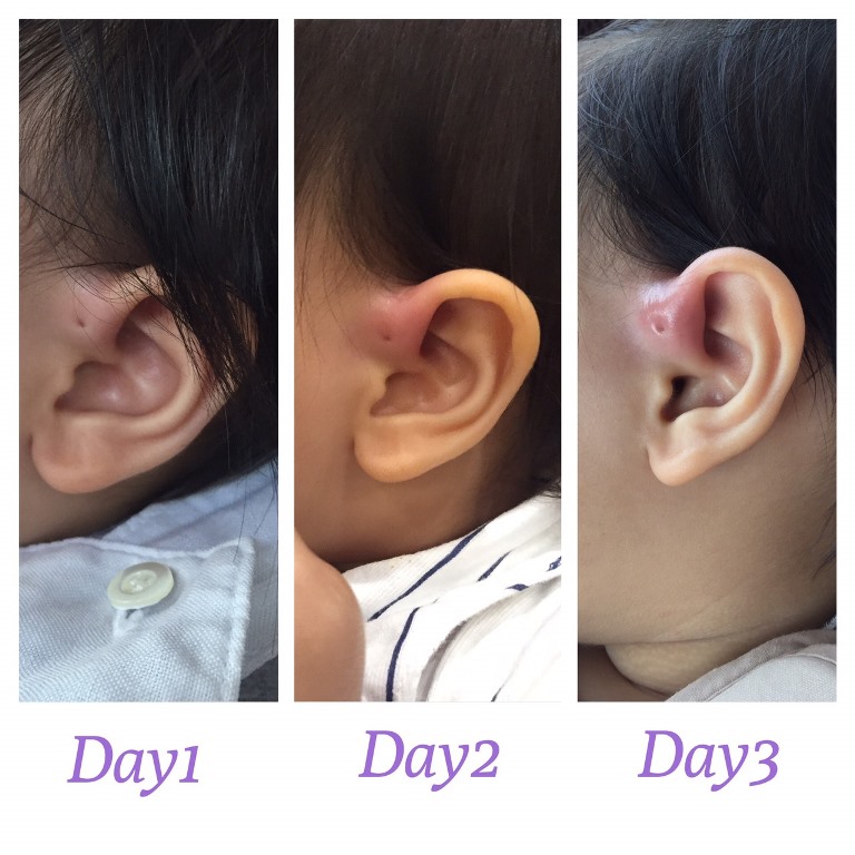 Ear pit, รูหูอักเสบ, มีรูตรงหู, Ear pit อักเสบ, การผ่า Ear pit, โรคภัยในเด็ก, เด็กเรียนว่ายน้ำ, ภัยเงียบ, การเลี้ยงลูกวัย 1-3 ปี
